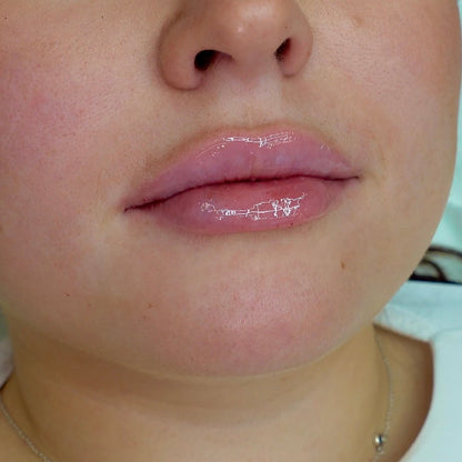 AfterMED Lips – Advanced Lip Recovery for Post-Treatment Care