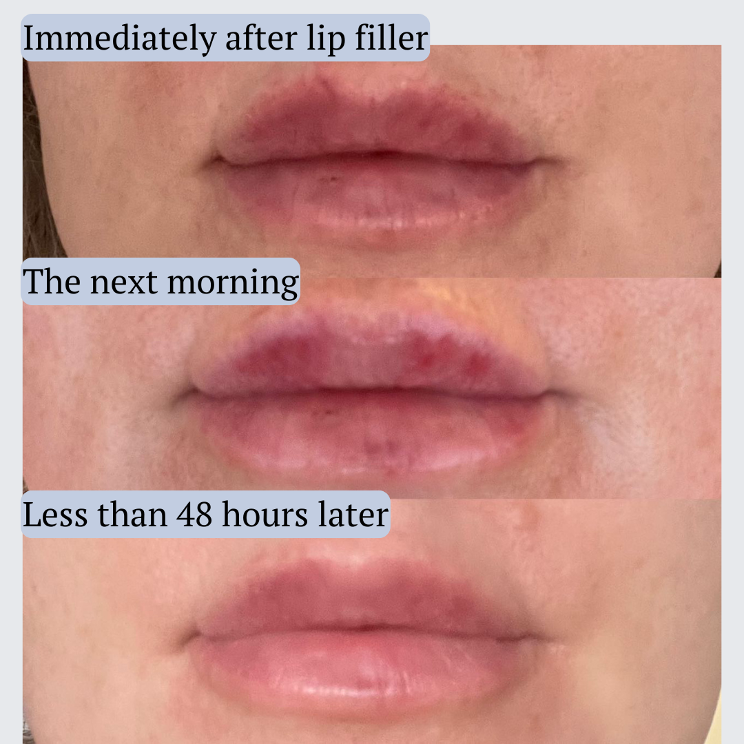 AfterMED Lips – Advanced Lip Recovery for Post-Treatment Care