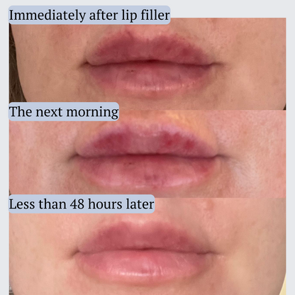 AfterMED Lips – Advanced Lip Recovery for Post-Treatment Care